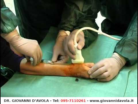 Qual è osteocondrosi come vylichit Il trattamento di dolori articolari a Kiev