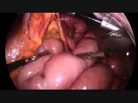 Misdiagnosis Of Internal Hernia In Pregnancy As Hyperemesis Gravidarum
