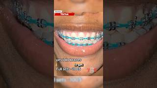 Memphis Woman Goes Viral For Doing "Basement Braces" 😬