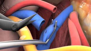 Lecture 2-6: Kidney transplant surgery video