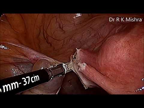 Hysterectomy - Surgical removal of the uterus full video