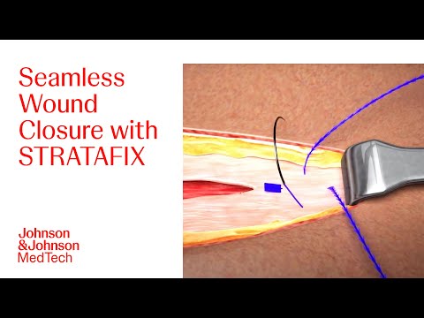 Step-by-Step Guide to Wound Closure using STRATAFIX in Open Surgery | J&J MedTech