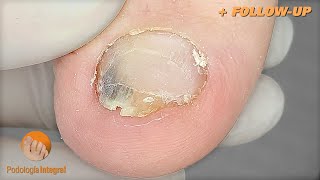 Toenail trimming and decompressive groove cleaning to relieve the pressure and discomfort