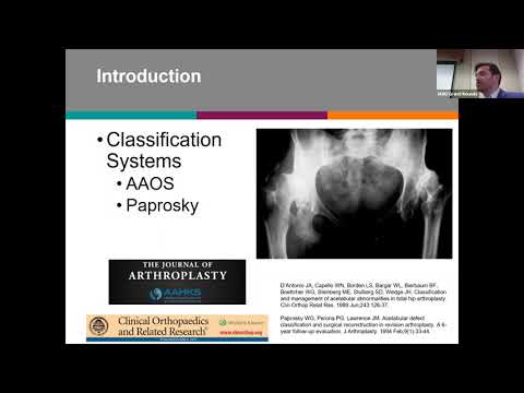 Complex Reconstruction of Acetabular Defects Trauma, Tumor, and Revision Arthroplasty   J Jolissaint