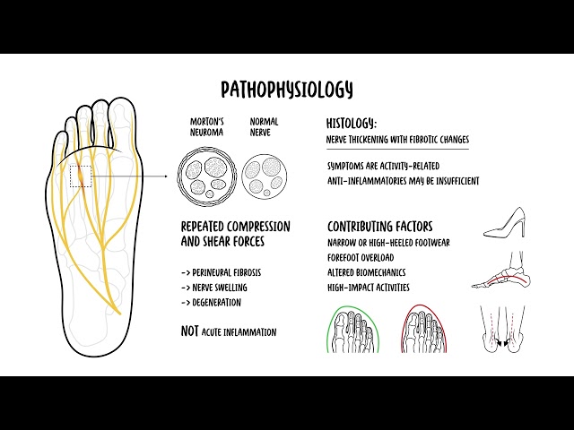 Morton’s Neuroma: Pathophysiology, Imaging & Management