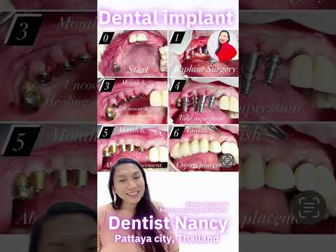 Dental implants