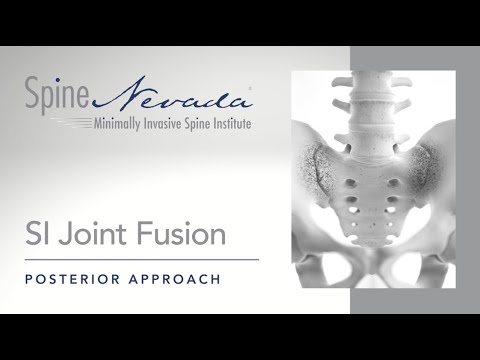 SI Joint Fusion at Spine Nevada in Reno, Sparks and Carson City