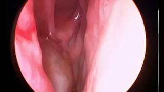 Cirugia endoscopica del mucocele maxilar - Institut Roura