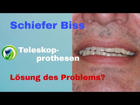 Mein Biss ist schief, was kann man noch machen? | Schiefe Zähne bei Prothesen | Ruhe-Schwebe-Lage