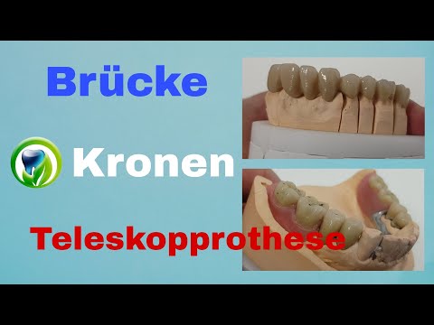Patientenfall | Teleskopprothese | Brücke, Kronen aus Vollkeramik - fest herausnehmbar Zahnersatz