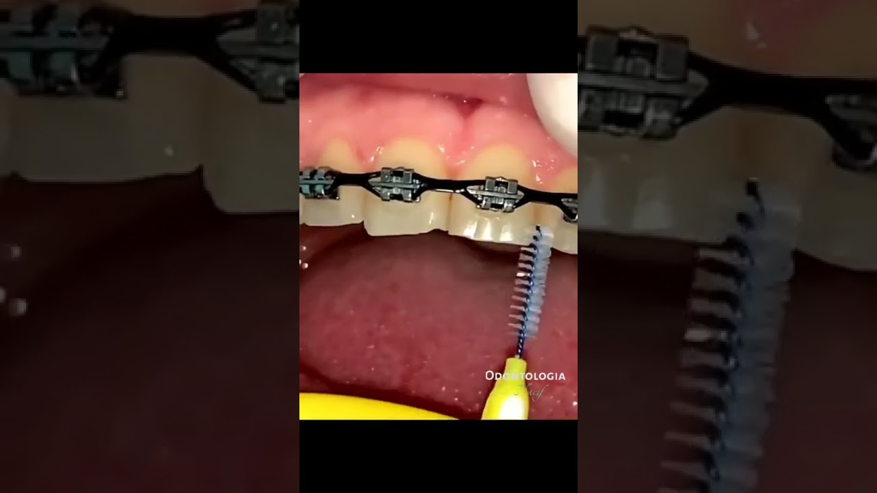 ESCOVA INTERDENTAL: COMO USAR para higiene de aparelho ortodôntico. DENTISTA RESPONDE