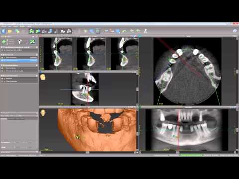 coDiagnostiX 9: Digitaler Workflow