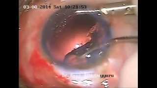 preview picture of video 'Maintainer Magics - use of anterior chamber maintainer in cataract surgery'