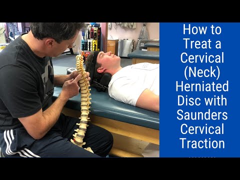 Positive Hoffman s Sign Hyperreflexia and Spurling s Test