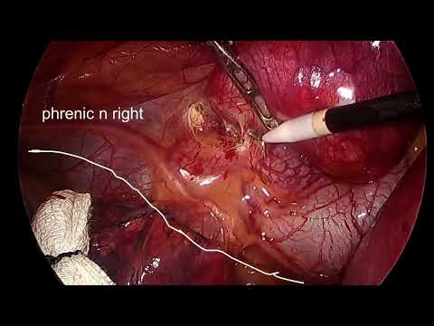 LAP Heller's Cardiomyotomy for Achalasia Cardia
