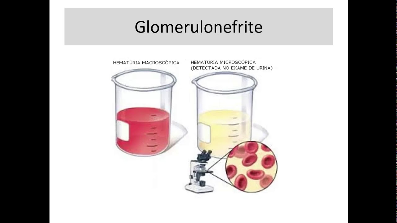 Fisiopatologia Renal: Síndrome nefrítica e Síndrome nefrótica.