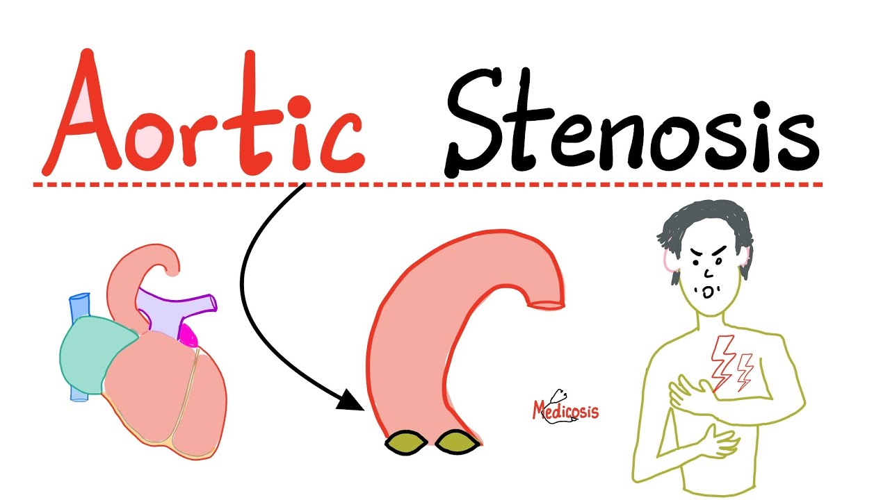 Aortic Stenosis (AS) - Valvular Heart Disease (VHD) - Causes, Symptoms, Diagnosis, Treatment -Cardio