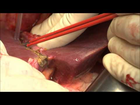 nonStick flush and maXium® – (EHT) hepatic parenchymal resection