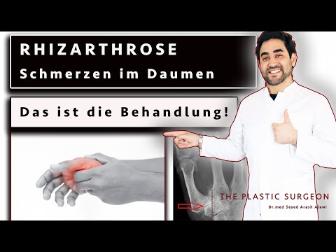 Rhizarthrosis - this is the treatment... | Pain in the thumb saddle joint | Dr. Alawi