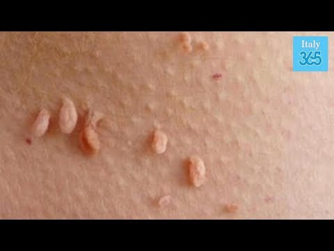 Che trattare pareti da parassiti Parassiti in cellulosa
