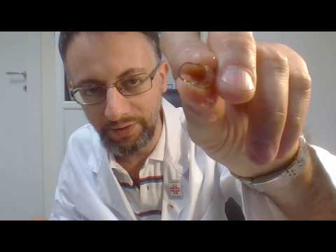 È reale per liberarsi da posti di pigmentary su una faccia Laceto di sidro di mela aiuta da posti di pigmentary