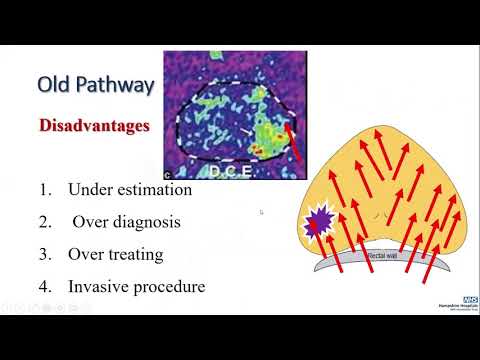 Targeted prostate biopsy talk