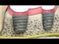 BioHorizons Tapered Short Implants