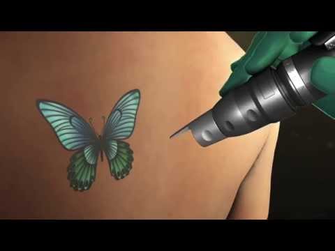 Watch: Vada Spa Tattoo Removal (opens on YouTube)