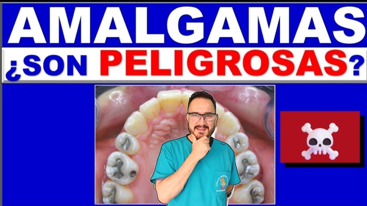 Watch Now AMALGAMA DENTAL DE PLATA CON MERCURIO MICROMERCURIALISMO AMALGAMA DENTAL DE PLATA CON MERCURIO MICROMERCURIALISMO