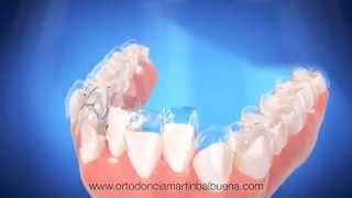 INVISALIGN ORTODONCIA INVISIBLE SEVILLA