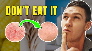 Top 5 Foods to Remove if you Have Psoriasis