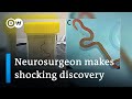 Neurosurgeon removes live worm from woman's brain in world-first discovery | DW News