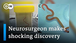 Neurosurgeon removes live worm from woman