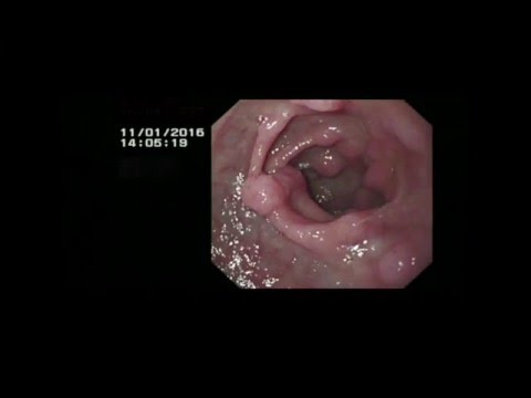 Ay posible na mawalan ng timbang sa pamamagitan ng pag-inom Kombucha sa Bakwit pagbaba ng timbang yogurt review