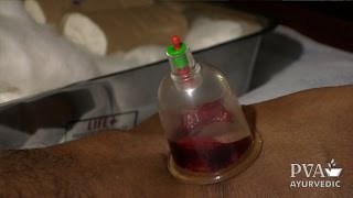 preview picture of video 'PVA: Hijama - Wet Cupping (Blood-letting) Therapy'