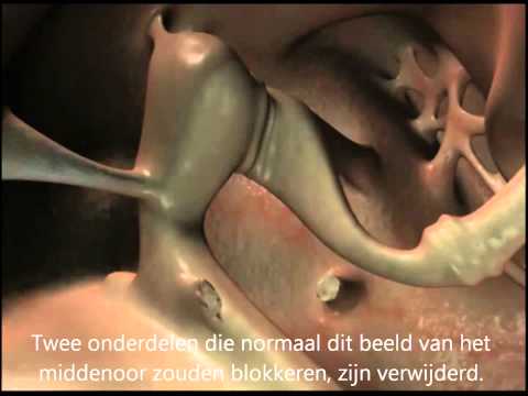 Auditory Transduction (NL subs)