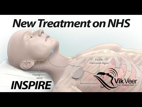 Inspire Hypoglossal Nerve Stimulator available on the NHS