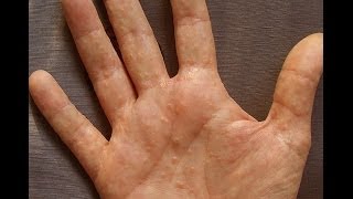 Dermatitis or Dyshidrosis How I Prevent Getting Painful And Unsightly Summer Hands