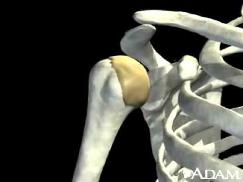 Shoulder joint dislocation