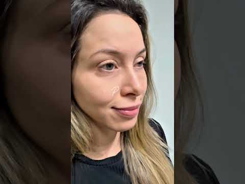 Cuidados após o preenchimento de olheiras