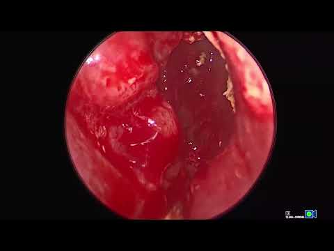 Live Surgery Part 2