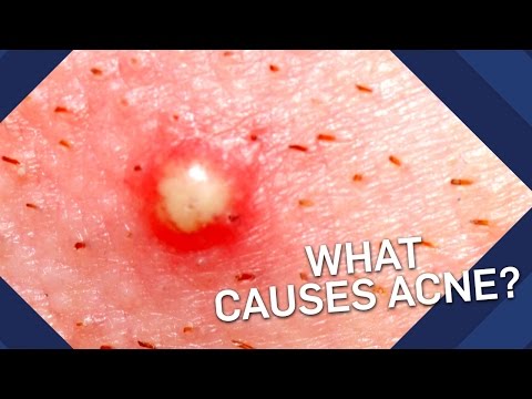 What Causes Acne? | Earth Science