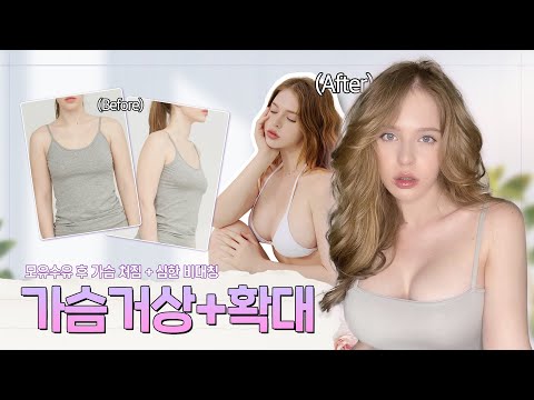 Khắc phục ngực sa trễ sau sinh, lấy lại độ nhô & sự săn chắc chỉ trong 1 lần✨ Review thực tế Nâng ngực & Treo sa trễ👙