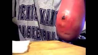 My Spider Bite Extraction. OH MY GOODNESS!!!