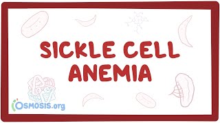 Download Lagu Sickle cell anemia - causes, symptoms, diagnosis, treatment u0026 pathology Thumbnail