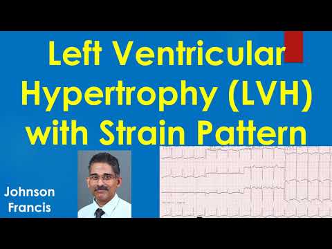 Left Ventricular Hypertrophy LVH with Strain Pattern on ECG