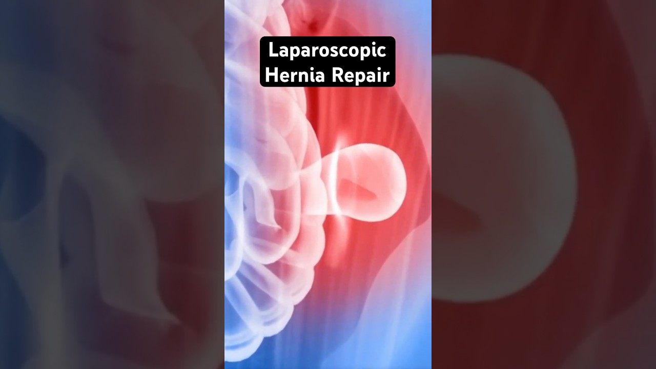 Pushing a hernia back into place (3D Animation)
