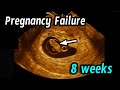 Early pregnancy failure 8 weeks 2 days