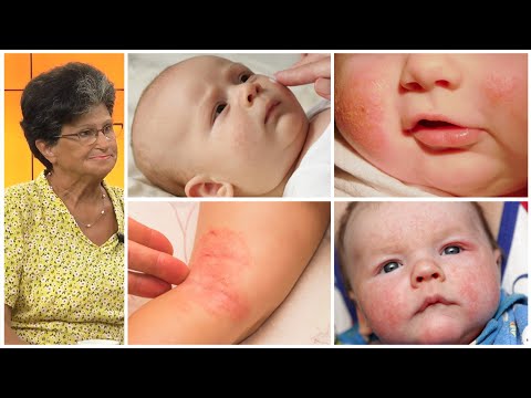 Dermatiti tek bebet në këto ditë të nxehta / Pediatria këshillon si të veprojmë…