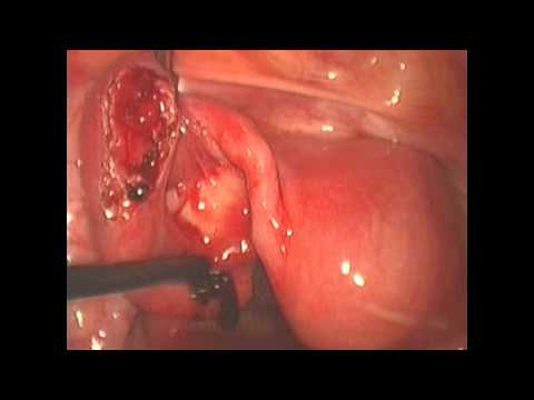 Liniowa salpingotomia w leczeniu ciąży pozamacicznej